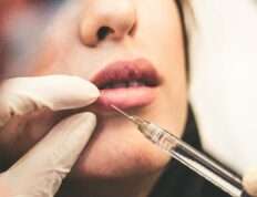 Lip Filler Treatment