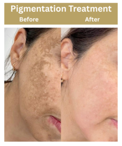 Pigmentation Treatment in Delhi | Dr Neha Batra