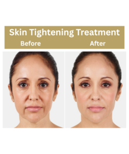 Skin Tightening Treatment in Delhi | Dr.  Neha Batra