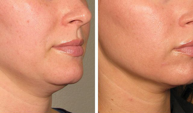 HIFU vs. RF vs. Laser: Which Skin Tightening Treatment Is Best for You in 2025?