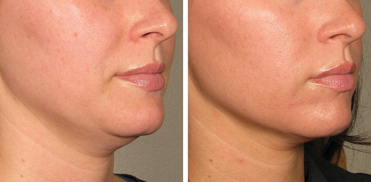 HIFU vs. RF vs. Laser: Which Skin Tightening Treatment Is Best for You in 2025?