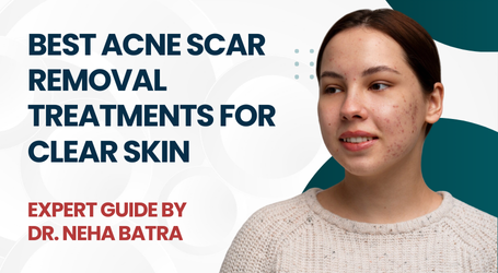 Best Acne Scar Removal Treatments for Clear Skin – Expert Guide by Dr. Neha Batra