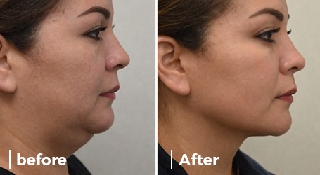 Best Double Chin Removal Clinic in Delhi | Dr. Neha Batra