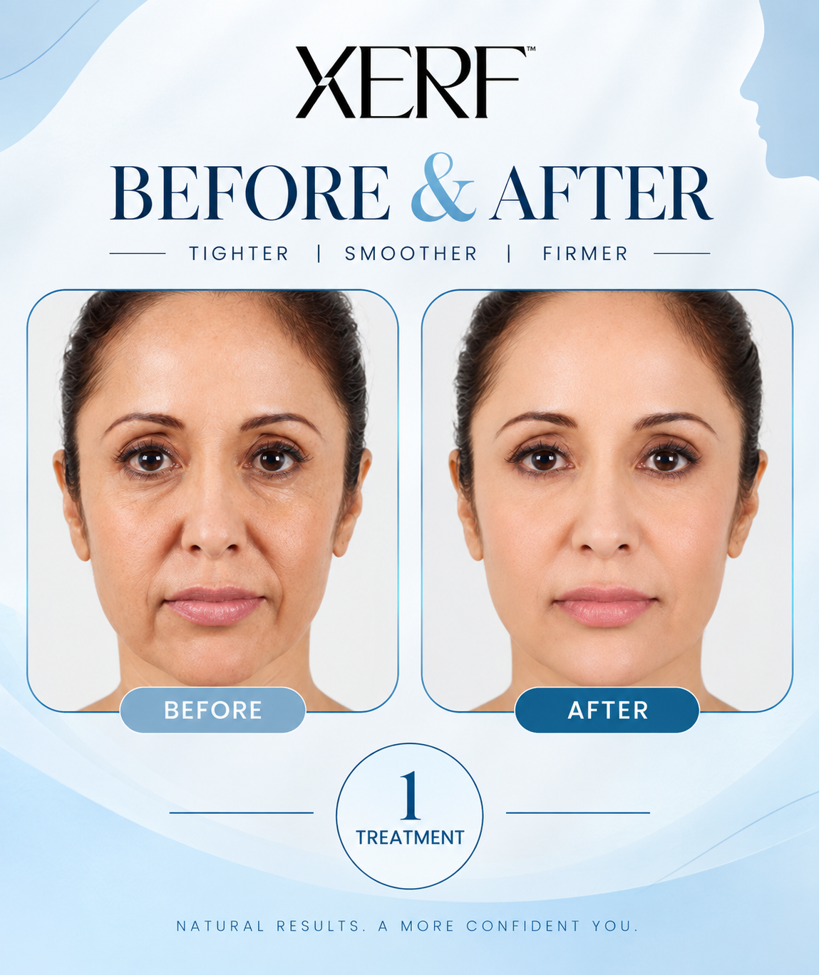 Xerf Treatment Before and After | Dr Neha Batra